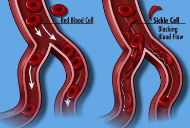 World Sickle Cell Day 2019: What you should know