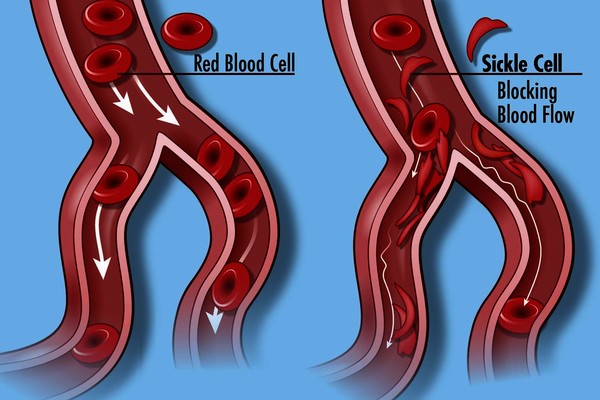 World Sickle Cell Day 2019: What you should know